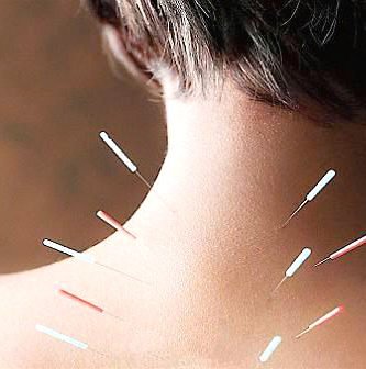 acupuntura en zona de cuello