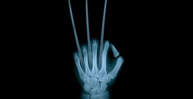 hueso de la mano