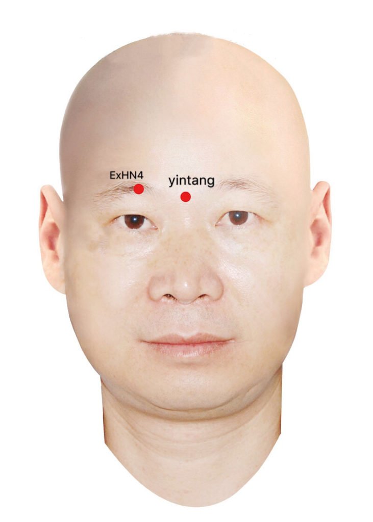 ex-hn3 yintang