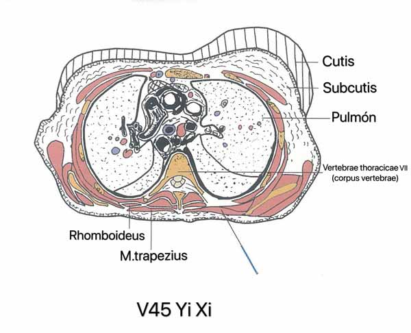 punto vejiga 45