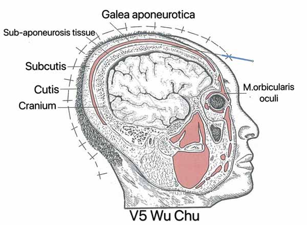 punto vejiga 5